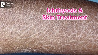 What is Ichthyosis How to Treat my Skin Fish like scales On SkinDrRasya Dixit  Doctors Circle [upl. by Aieka496]