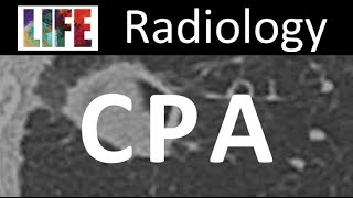 Radiology of chronic pulmonary aspergillosis [upl. by Nessah]