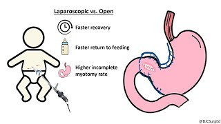 Hypertrophic Pyloric Stenosis [upl. by Anialam]